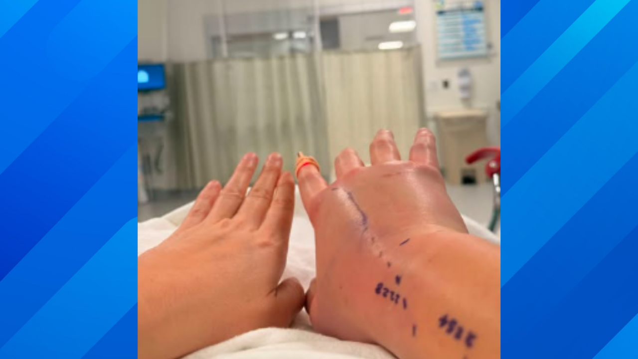 Woman goes viral for copperhead bite